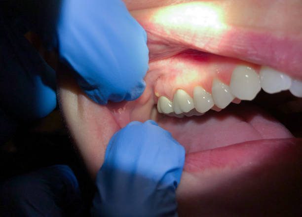 Best Emergency Tooth Extraction in Caldwell, TX